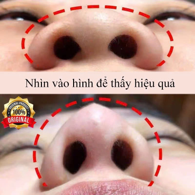 Tinh Dầu Nâng Sống Mũi 10ml – Làm Đẹp Mũi Tự Nhiên, Không Đau, Hiệu Quả Tại Nhà , đèn ốp trần