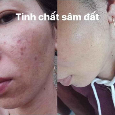 Tinh Chất Sâm Đất DR CELL 50ml tái tạo da, triệt tiêu mụn, mờ thâm nám, thu nhỏ chân lông
