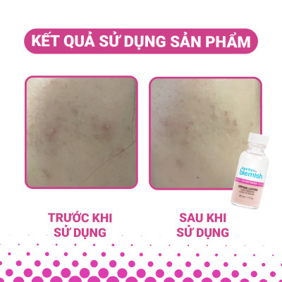 Chấm Mụn Giảm Mụn Nhanh Sau 1 Đêm Dành Cho Mụn Trắng, Sưng Đỏ Bye Bye Blemish Original Drying Lotion 30ml