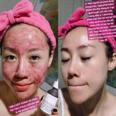 Tinh Chất Thay Da Sinh Học Tẩy Tế Bào Chết da Mặt So’Natural Red Peel Tingle Serum 35ml