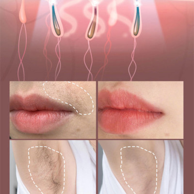 Máy triệt lông, trẻ hoá da công nghệ IPL, hiệu suất cao super Photon NanoTime B62F